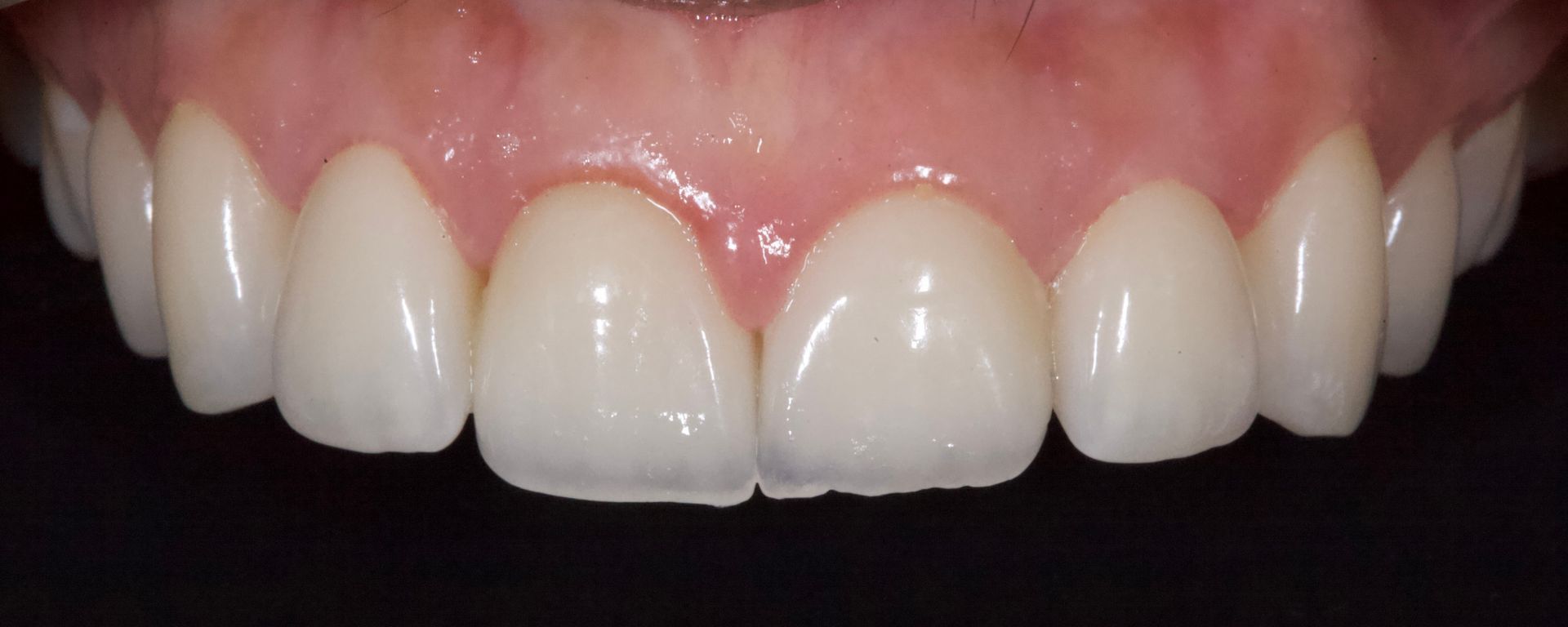 After Bottom Teeth — Menai, NSW — Top Care Dental