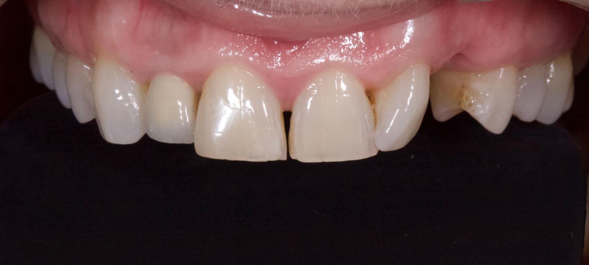 Before Teeth Close-Up — Menai, NSW — Top Care Dental