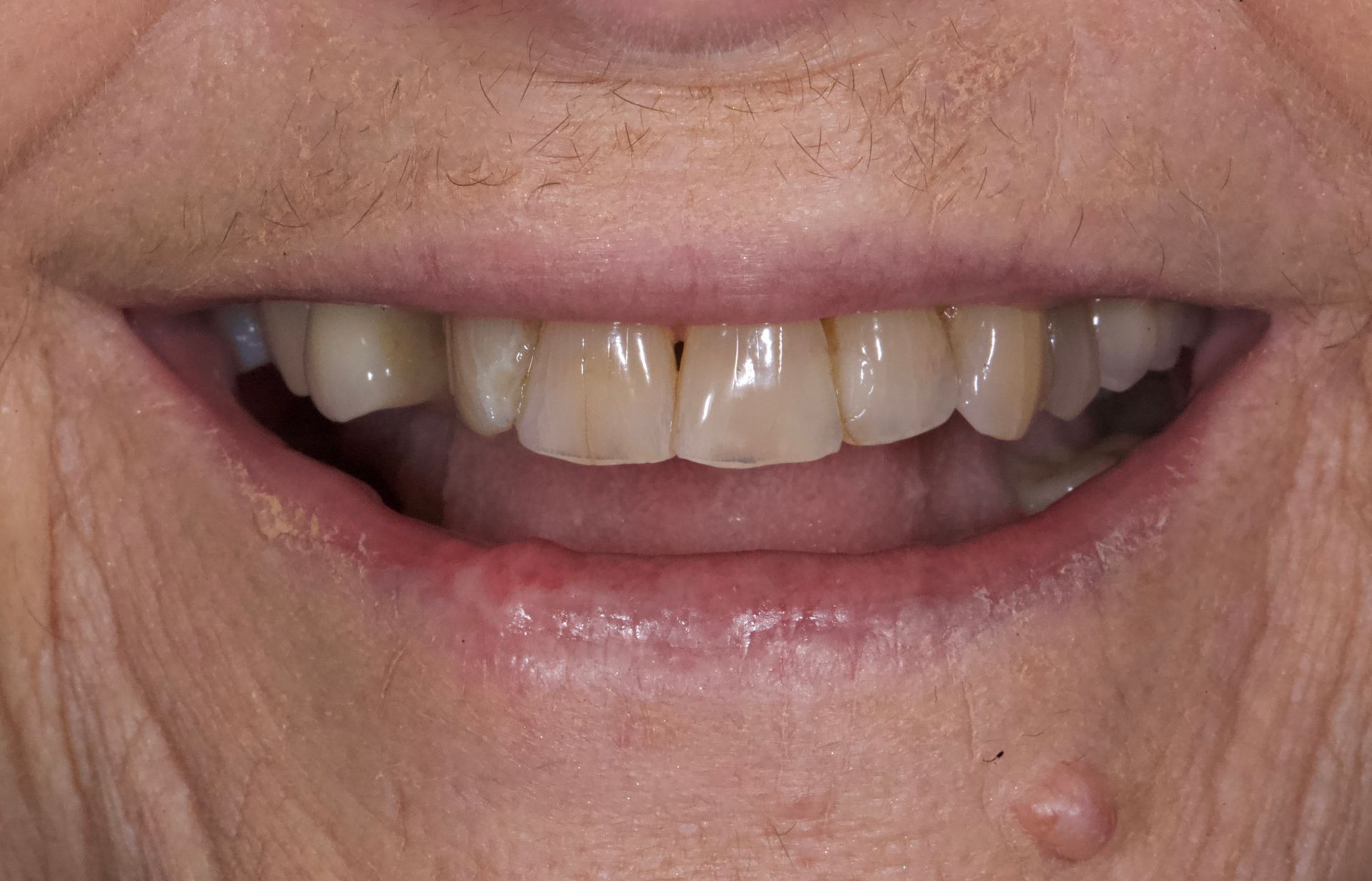 Before Bottom Teeth — Menai, NSW — Top Care Dental