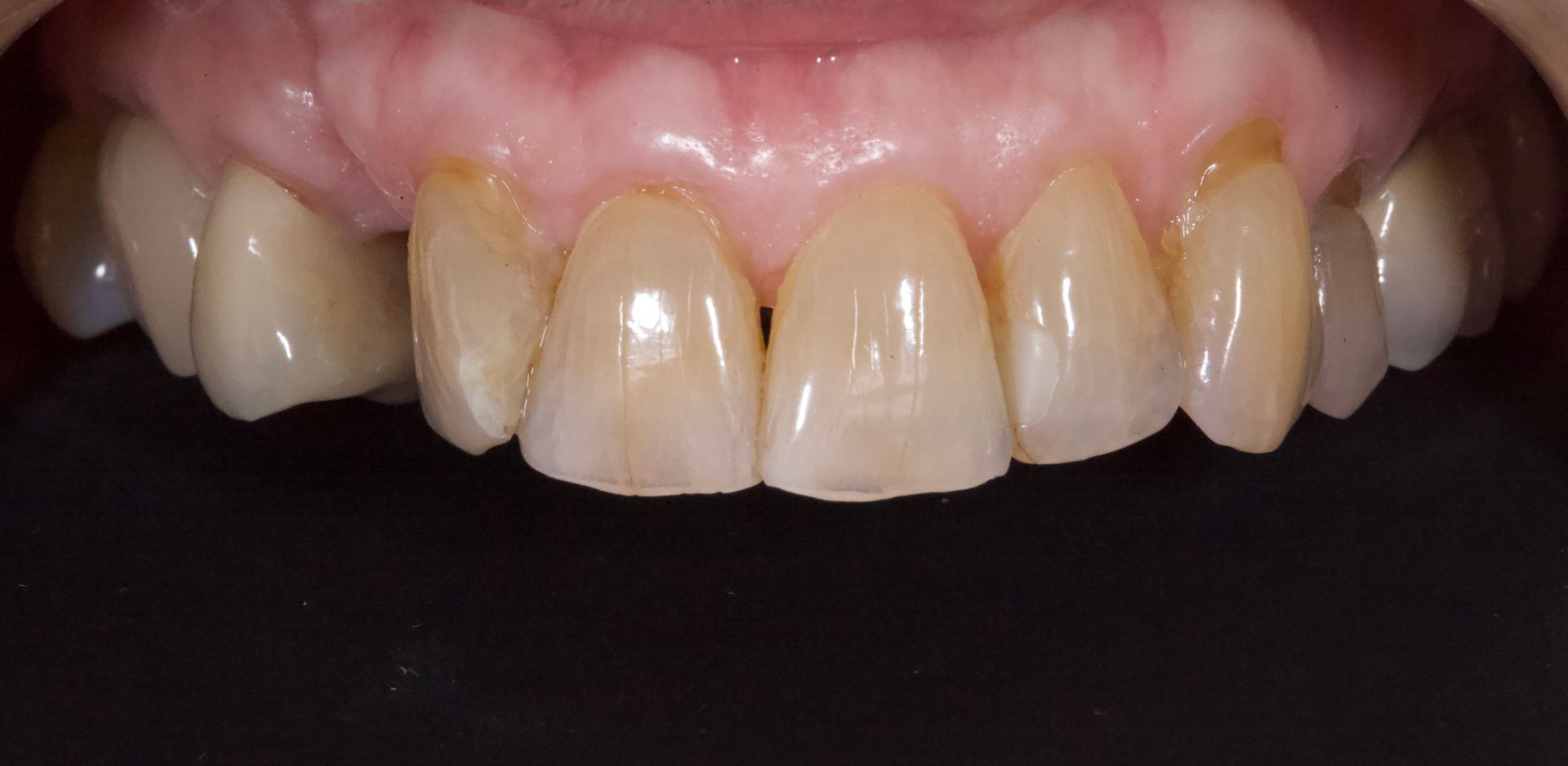 Before Bottom Teeth — Menai, NSW — Top Care Dental