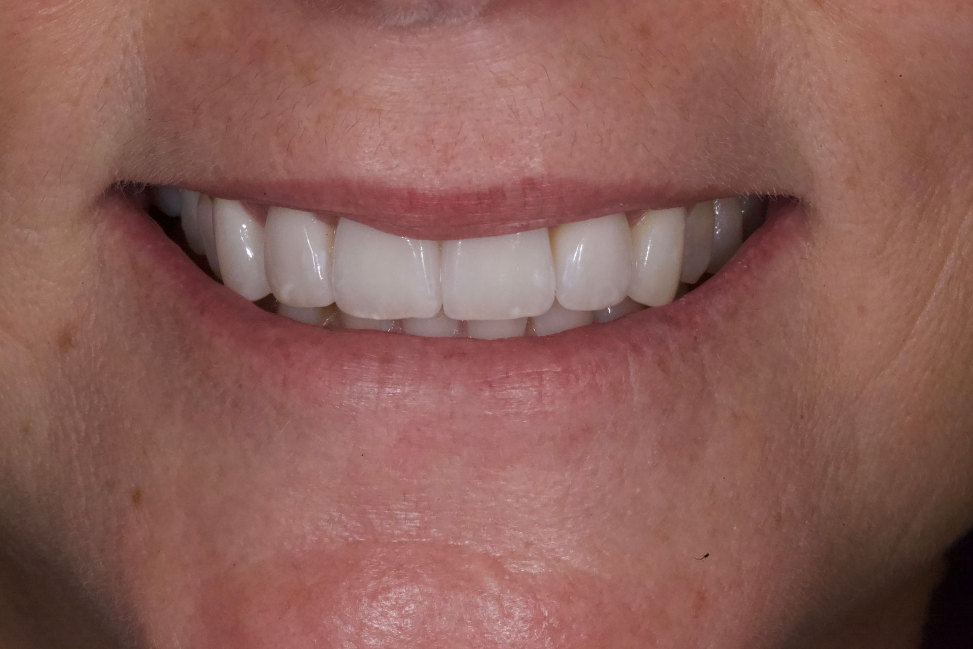 After Bottom Teeth — Menai, NSW — Top Care Dental