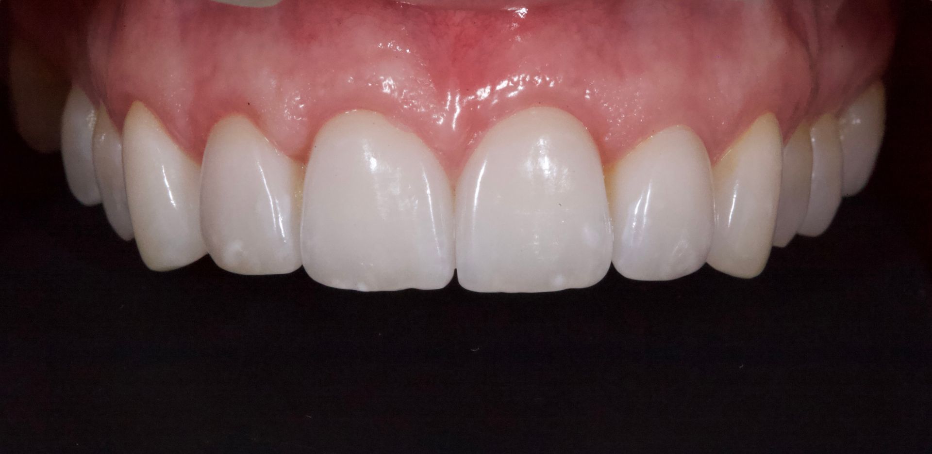 After Bottom Teeth — Menai, NSW — Top Care Dental