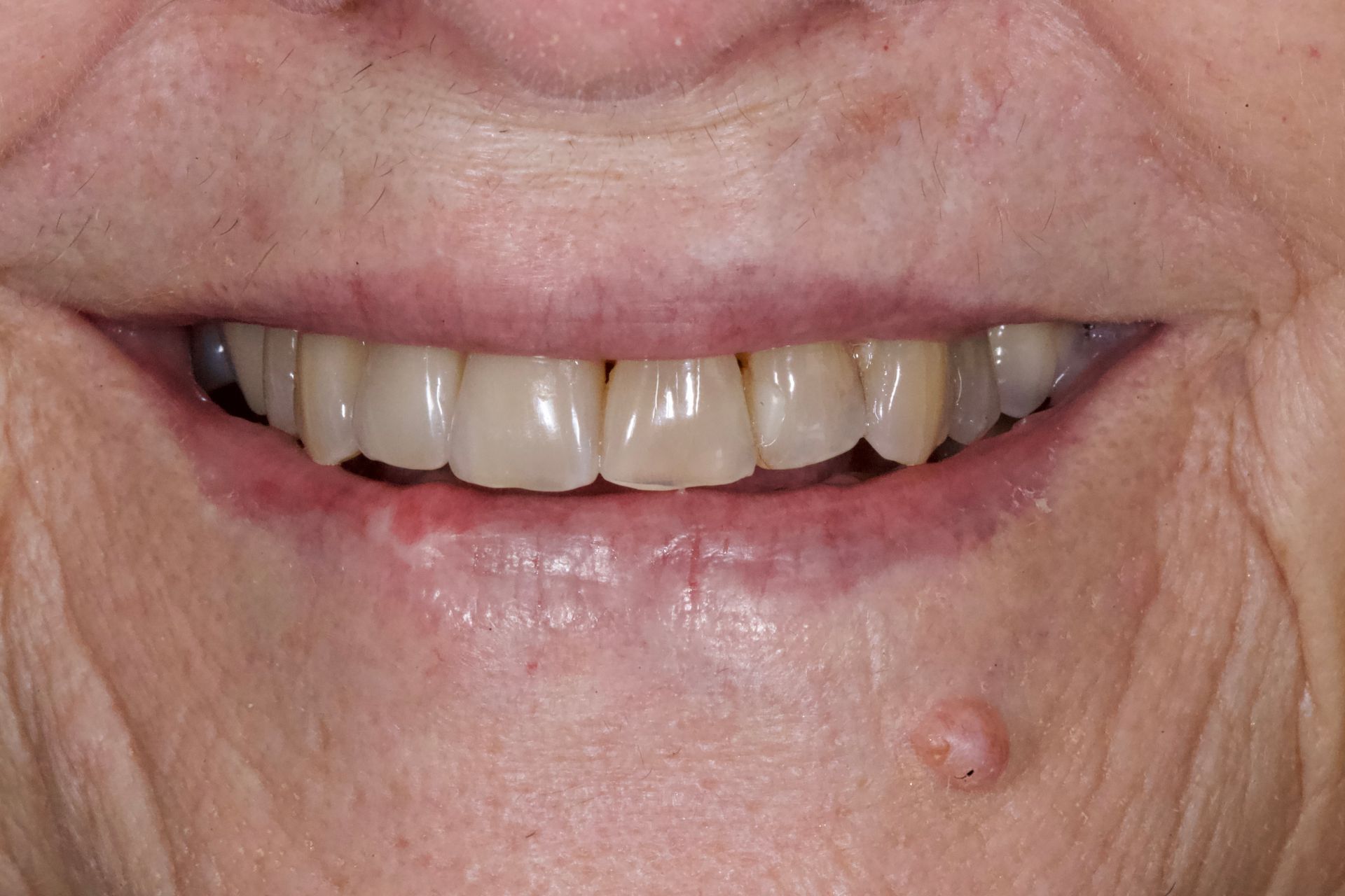 After Bottom Teeth — Menai, NSW — Top Care Dental