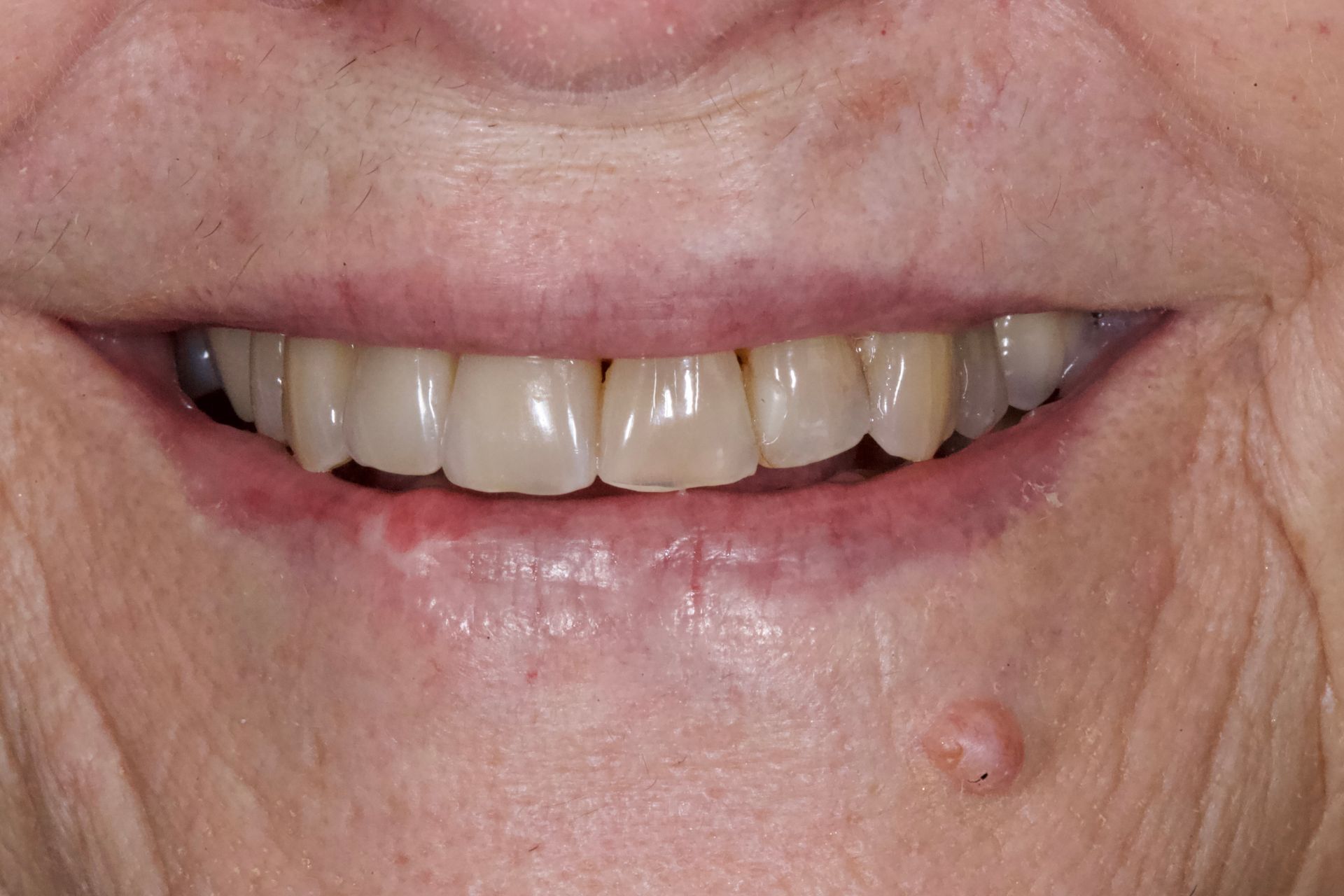 After Bottom Teeth — Menai, NSW — Top Care Dental