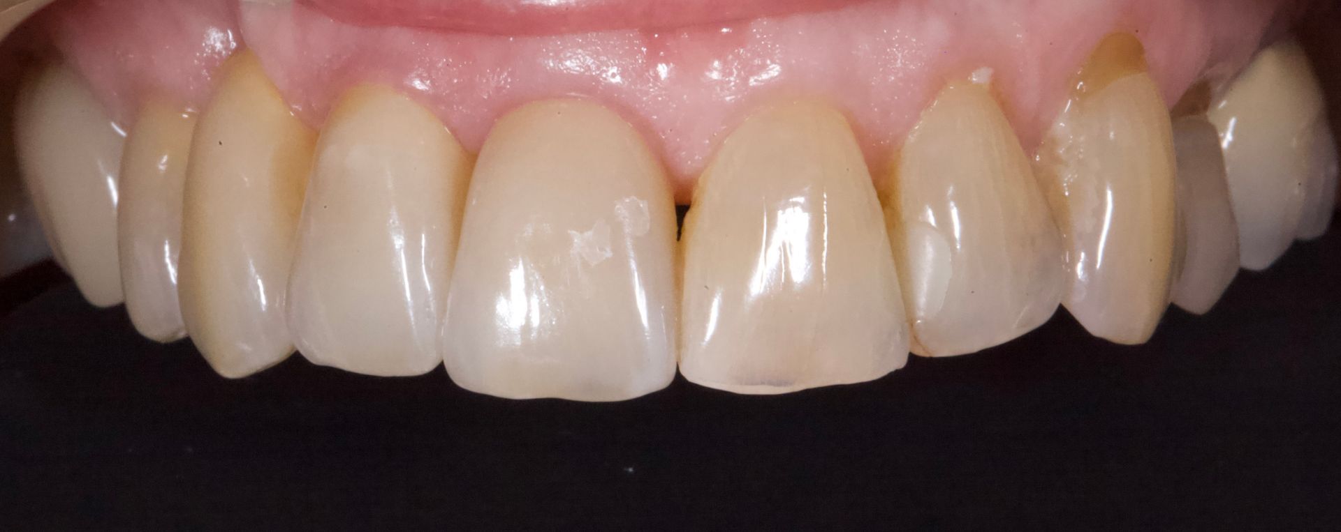 After Bottom Teeth — Menai, NSW — Top Care Dental