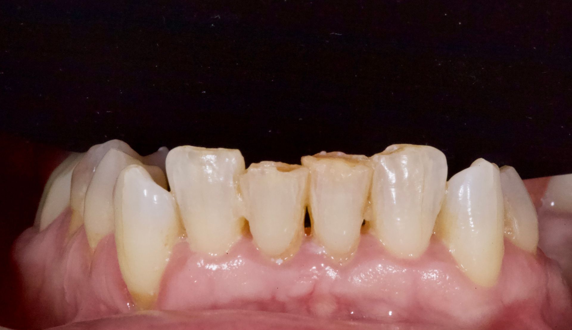 Before Bottom Teeth — Menai, NSW — Top Care Dental