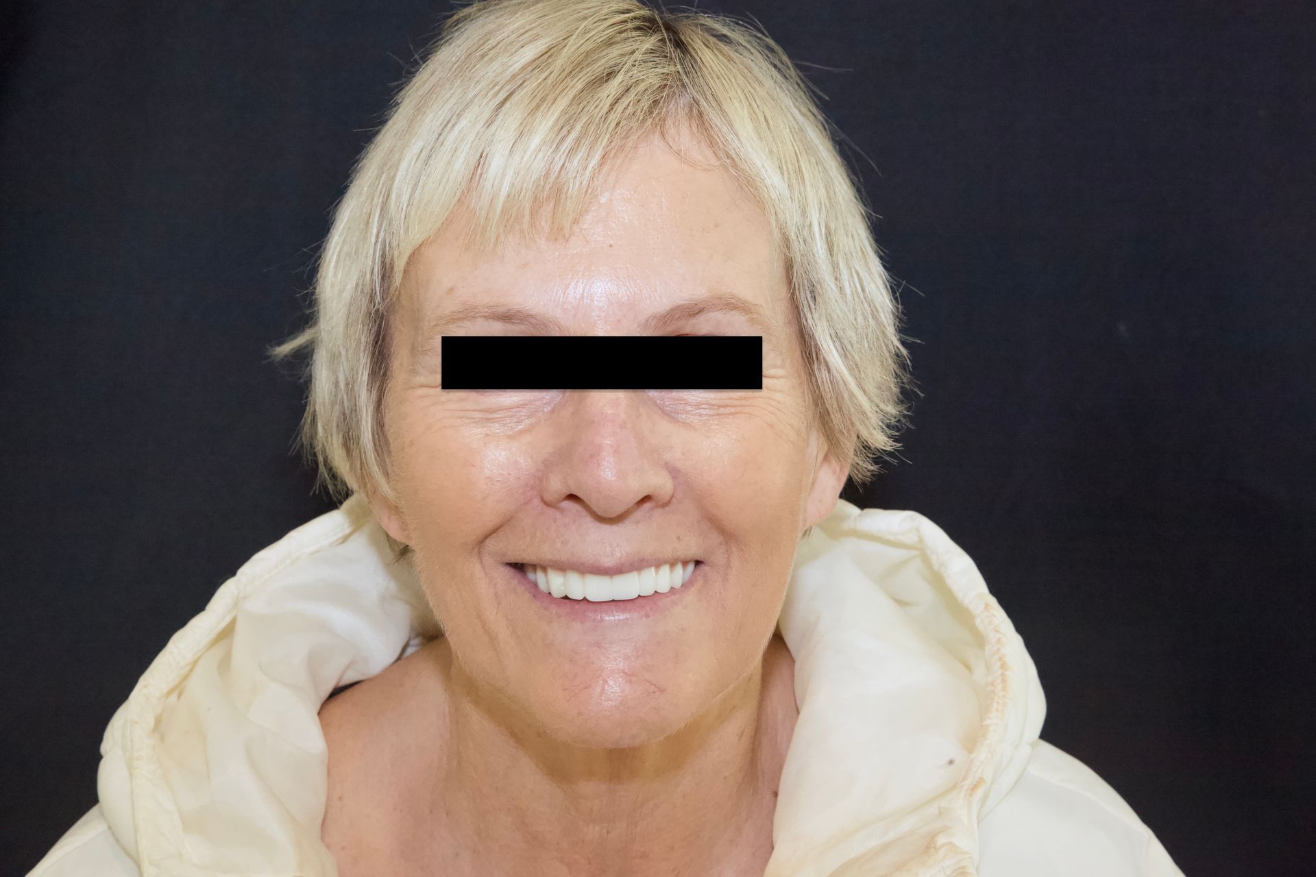 After Teeth Close-Up — Menai, NSW — Top Care Dental