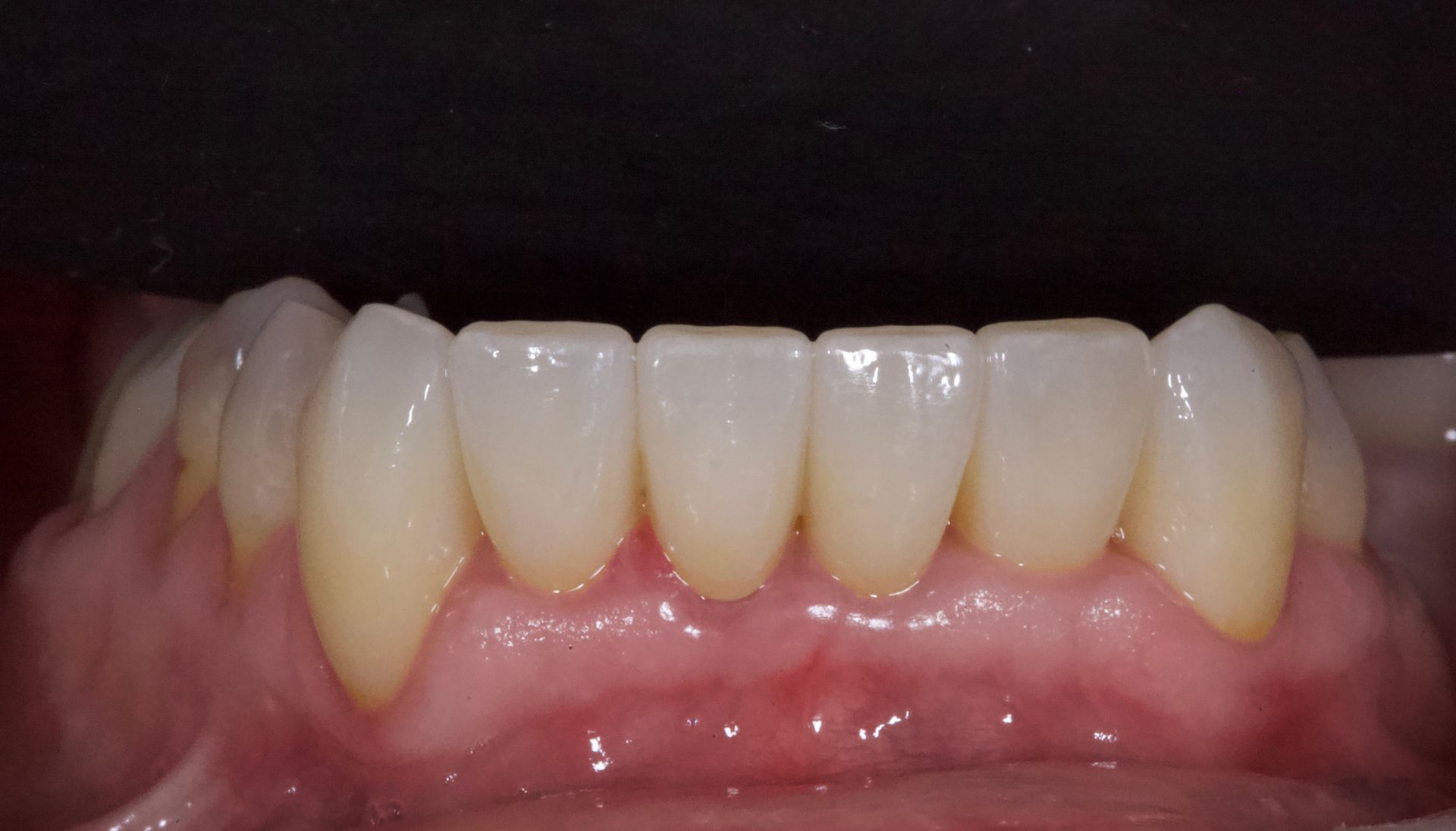 After Bottom Teeth — Menai, NSW — Top Care Dental