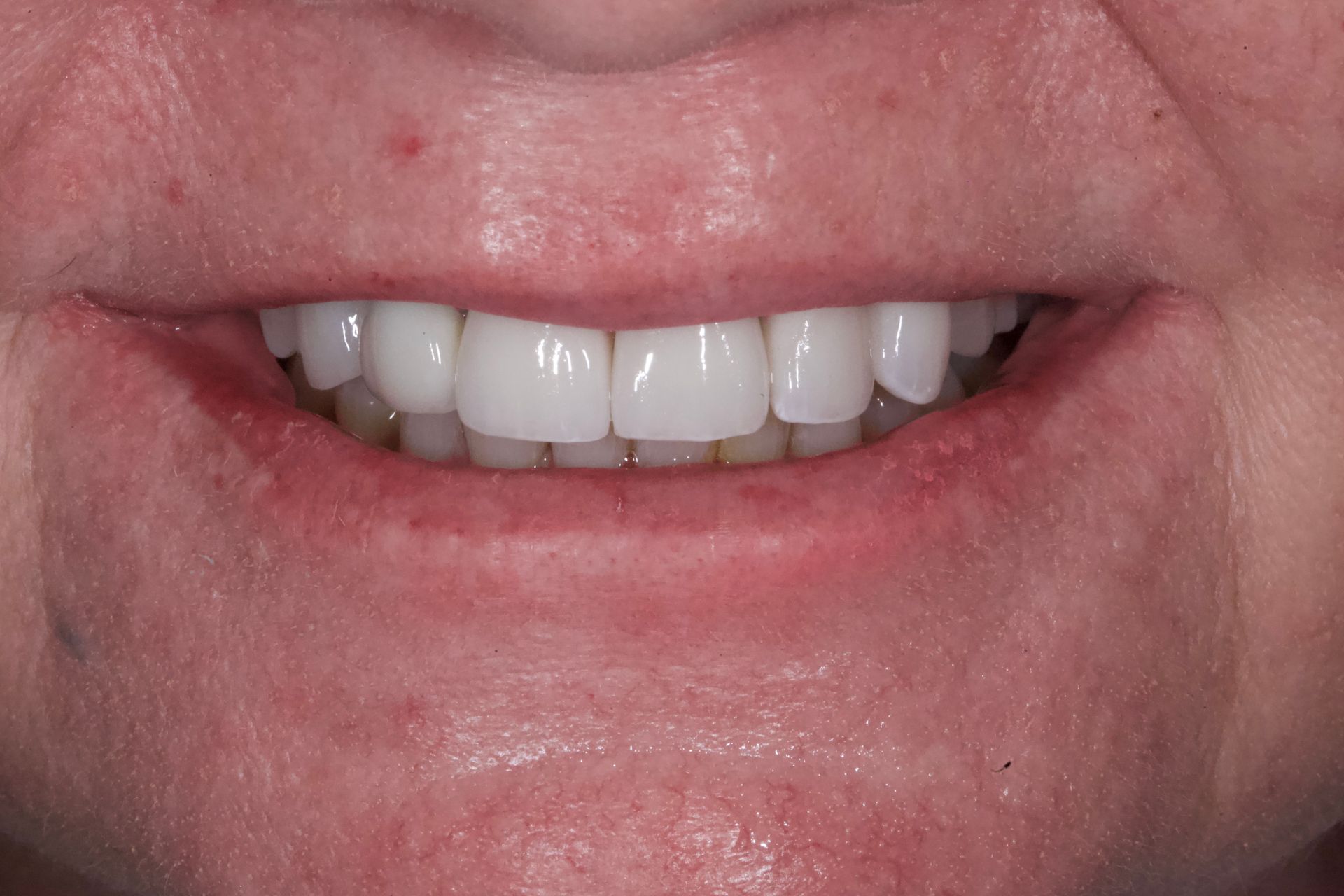 After Bottom Teeth — Menai, NSW — Top Care Dental