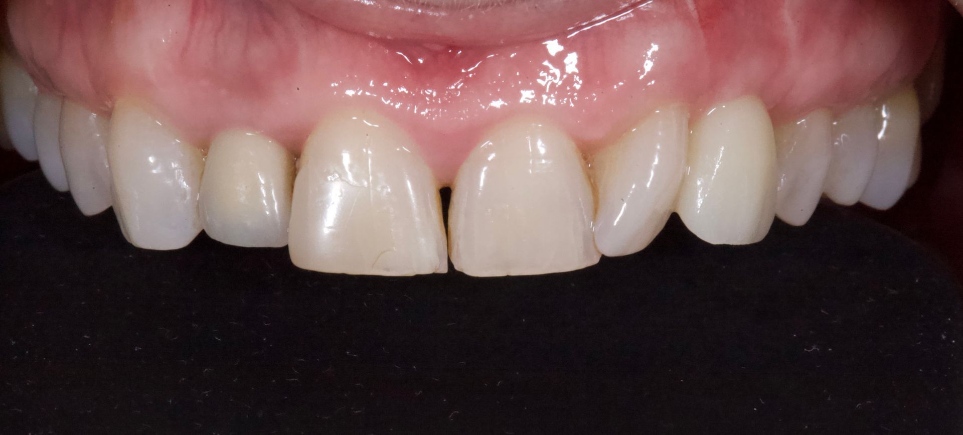 After Teeth Close-Up — Menai, NSW — Top Care Dental