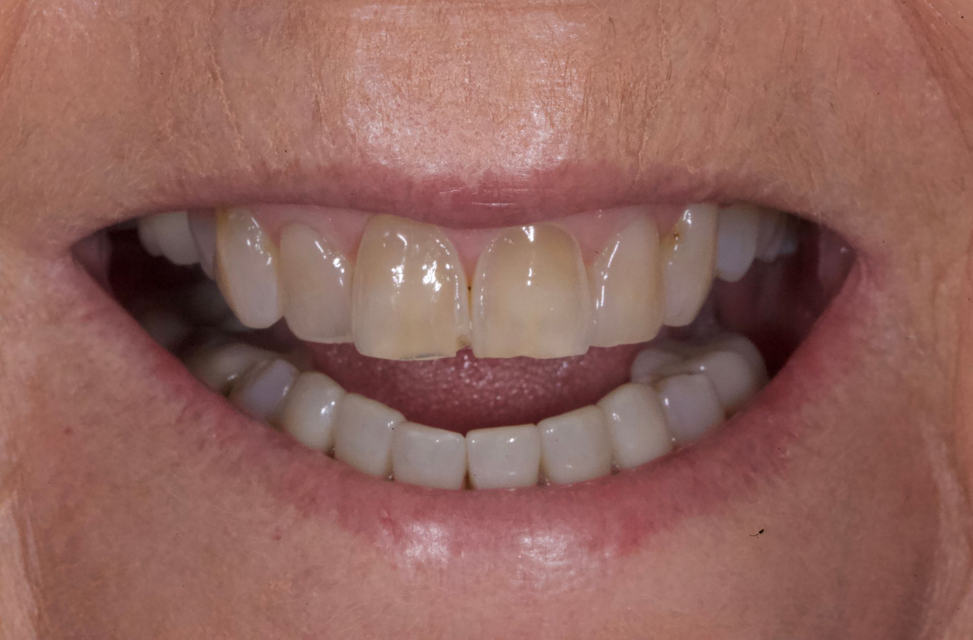 Before Bottom Teeth — Menai, NSW — Top Care Dental