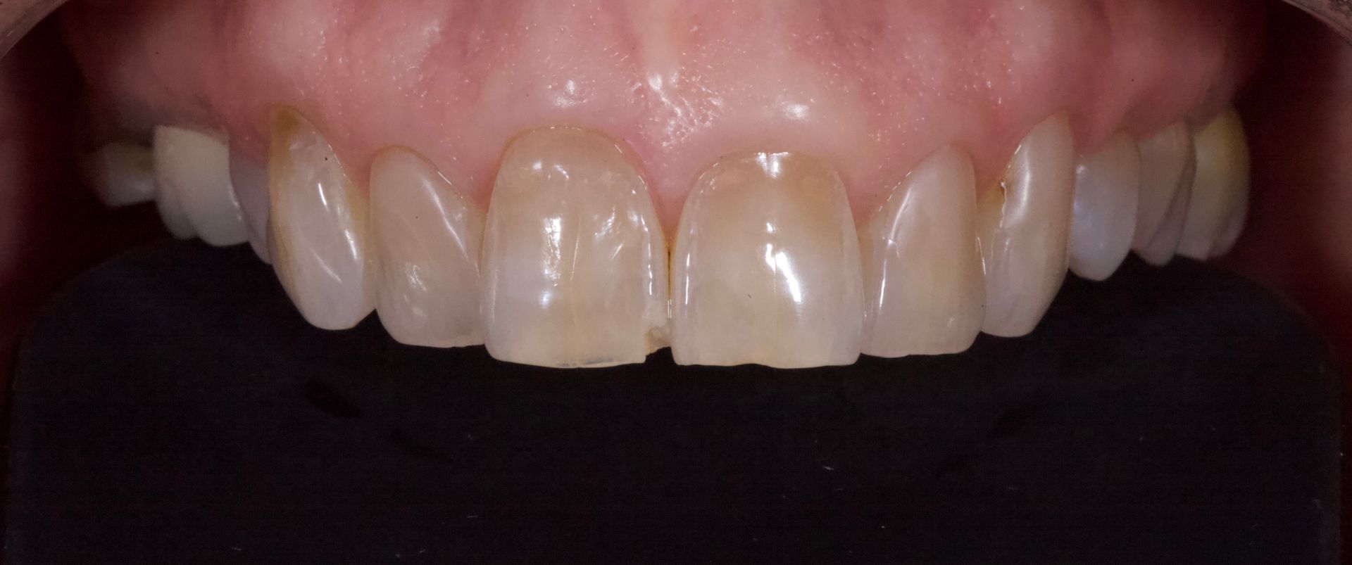 Before Bottom Teeth — Menai, NSW — Top Care Dental