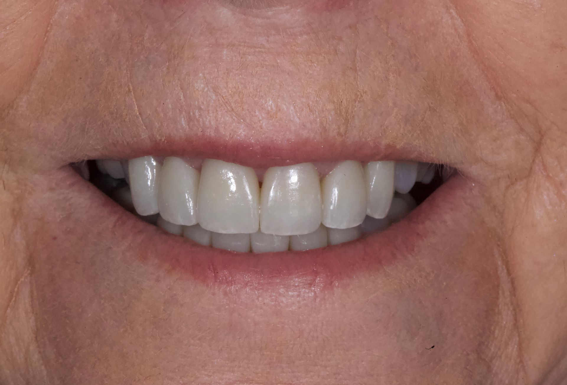 After Bottom Teeth — Menai, NSW — Top Care Dental