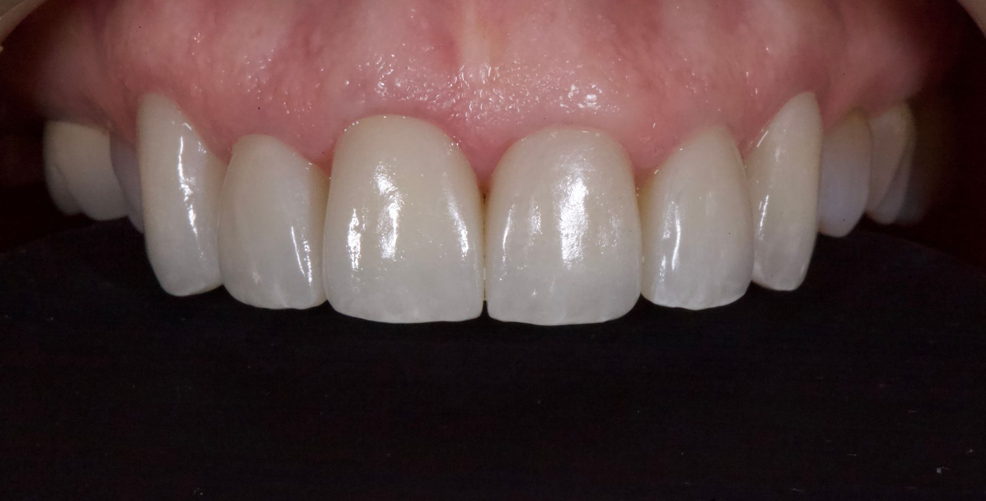 After Bottom Teeth — Menai, NSW — Top Care Dental