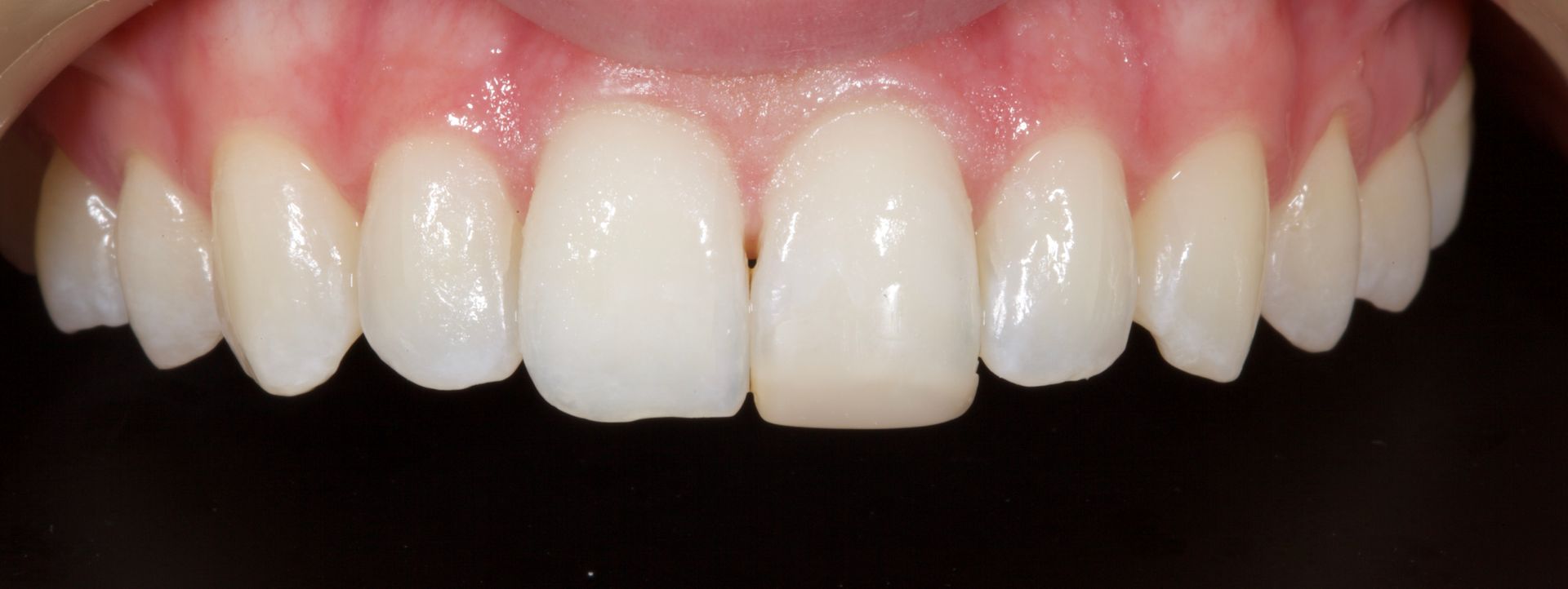 Before Upper Teeth Porcelain Veneers — Menai, NSW — Top Care Dental