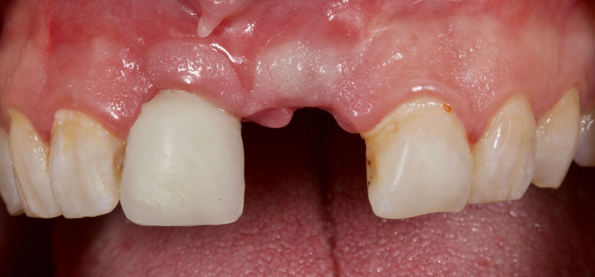 Before Male Teeth Close-Up — Menai, NSW — Top Care Dental