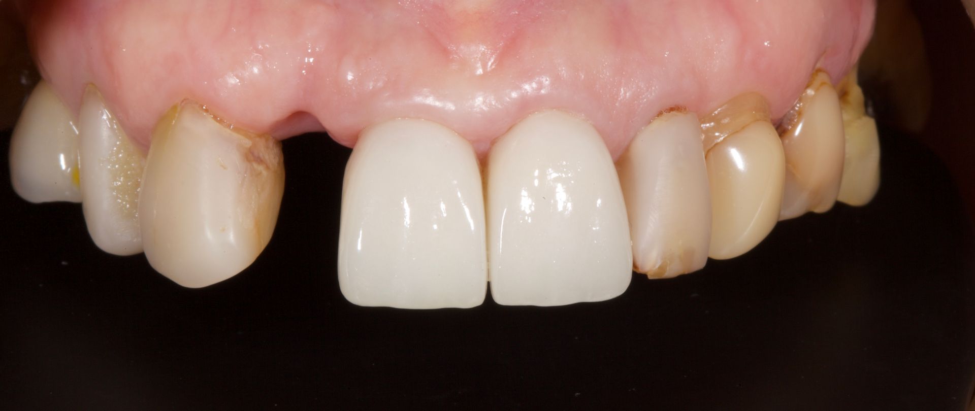 Before Tooth Implant — Menai, NSW — Top Care Dental