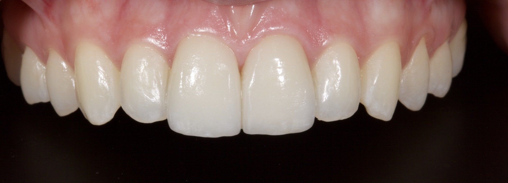 After Upper Teeth Porcelain Veneers — Menai, NSW — Top Care Dental