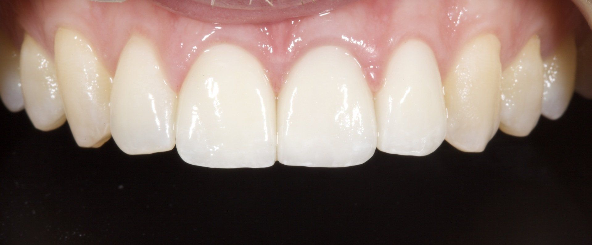 After Broken Front Teeth — Menai, NSW — Top Care Dental