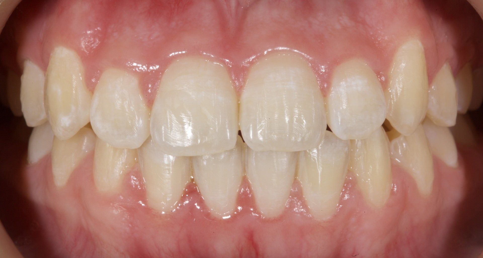 Crooked Teeth After — Menai, NSW — Top Care Dental