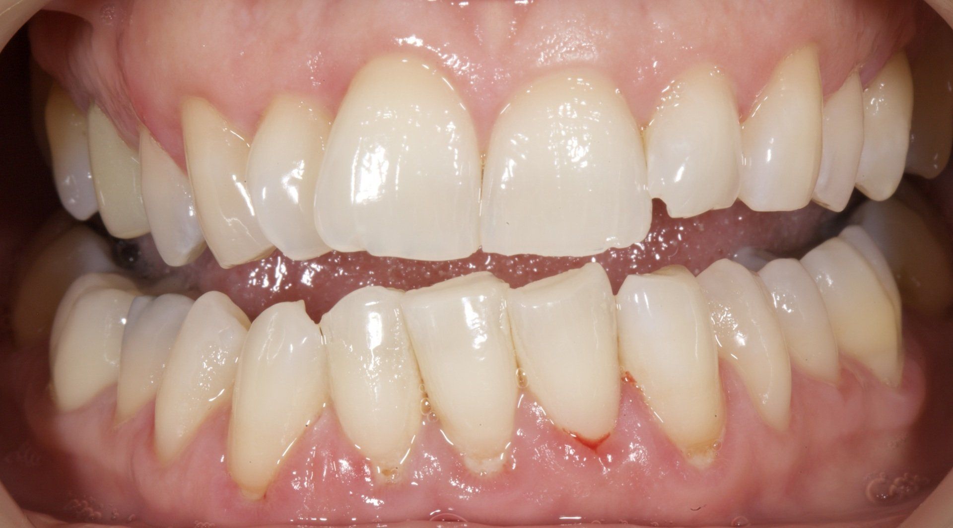 White Teeth After — Menai, NSW — Top Care Dental