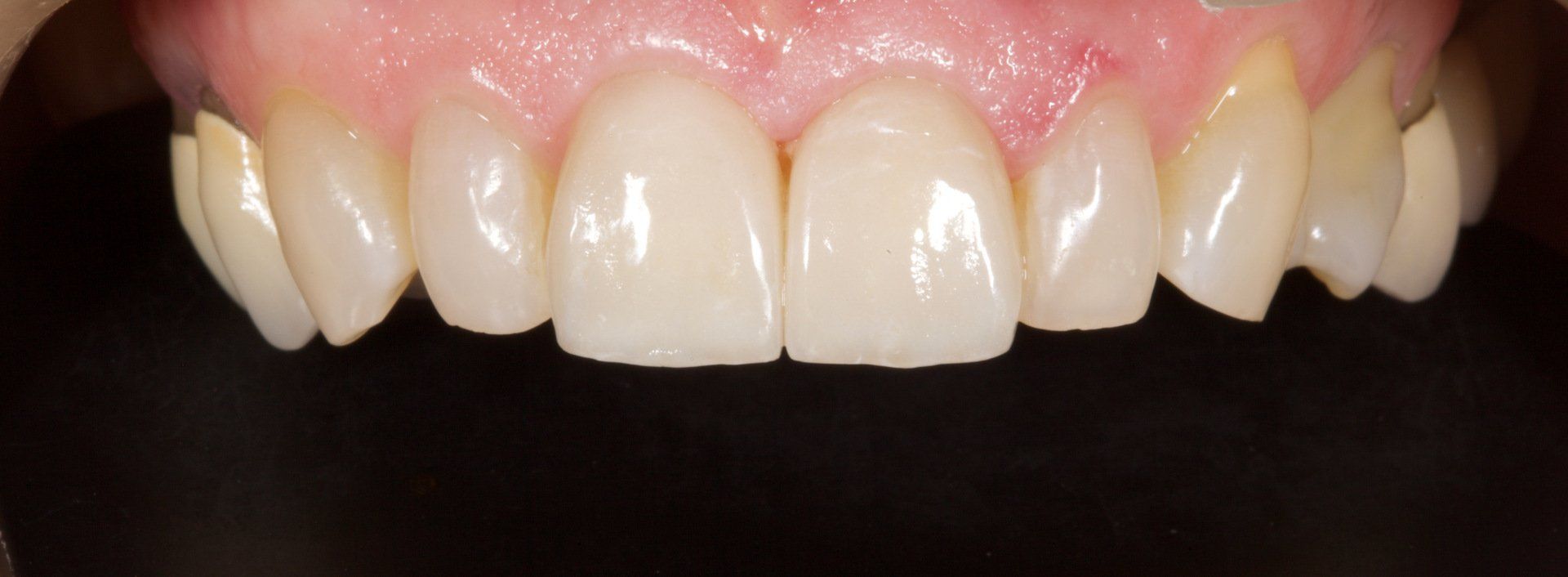 Teeth After Porcelain Veneers — Menai, NSW — Top Care Dental