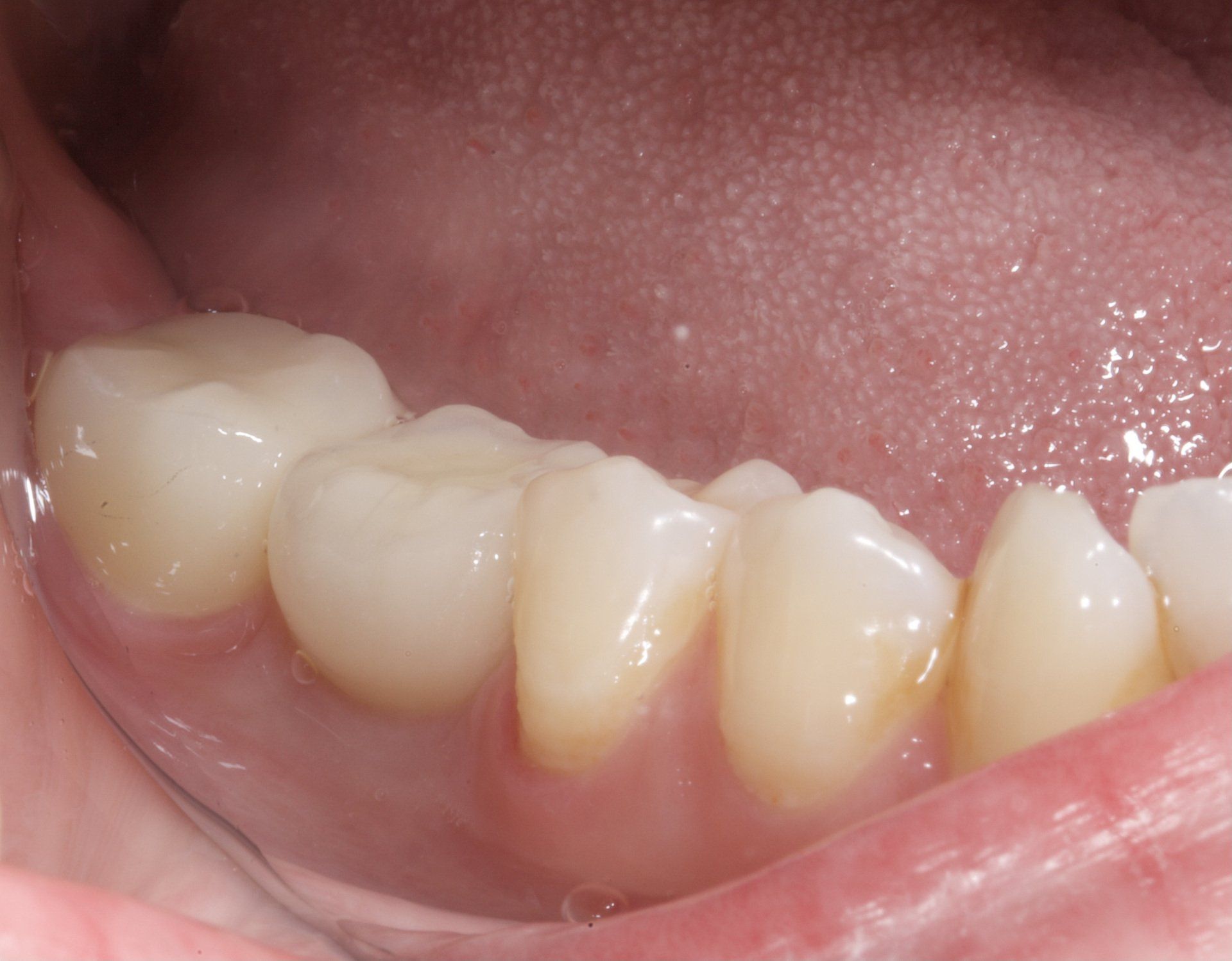 After Bicuspids Implant — Menai, NSW — Top Care Dental