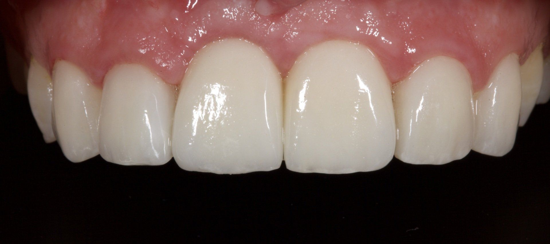 After Male Teeth Close-Up — Menai, NSW — Top Care Dental