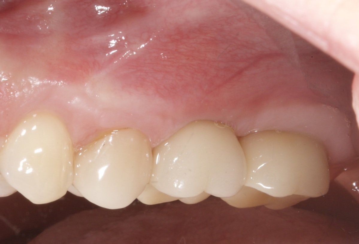 After Top Molars Implant — Menai, NSW — Top Care Dental