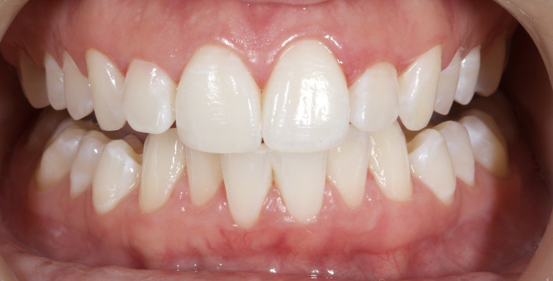 Teeth Whitening After — Menai, NSW — Top Care Dental