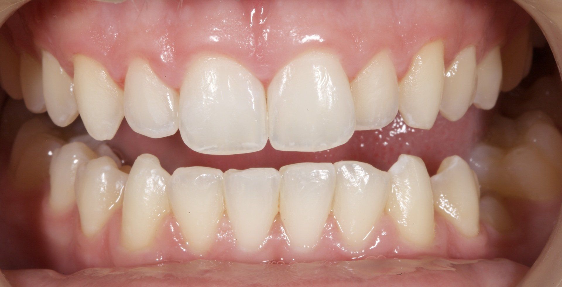 After Teeth Whitening Close-Up — Menai, NSW — Top Care Dental