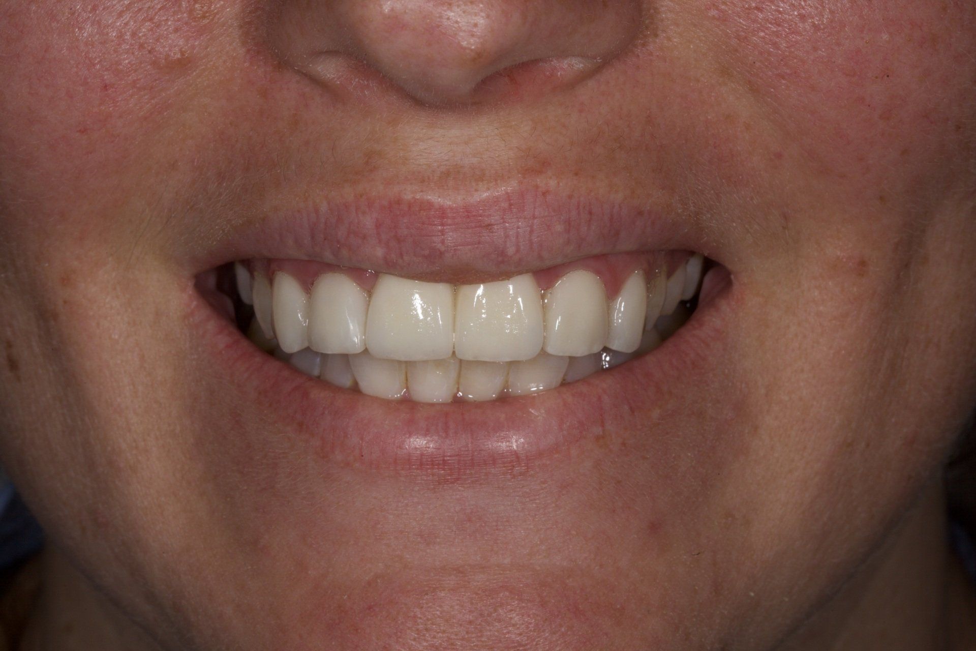 After Male Teeth — Menai, NSW — Top Care Dental