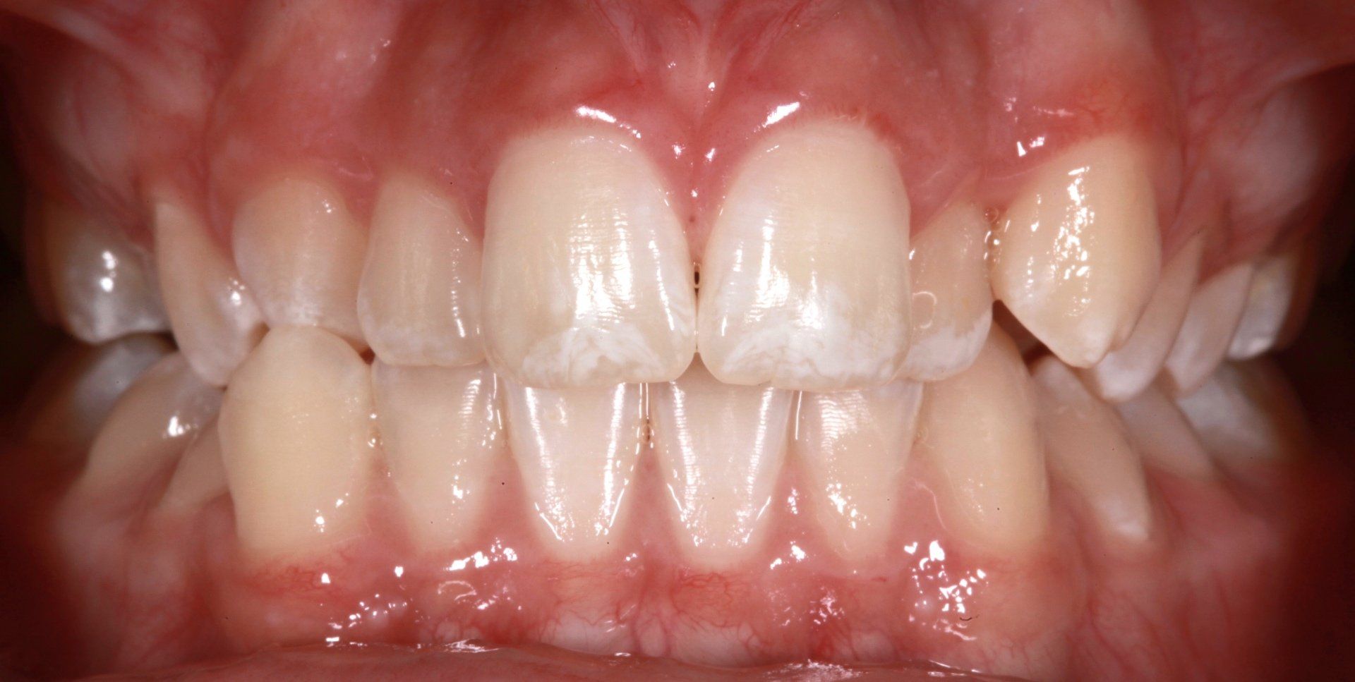Orthodontic Before — Menai, NSW — Top Care Dental