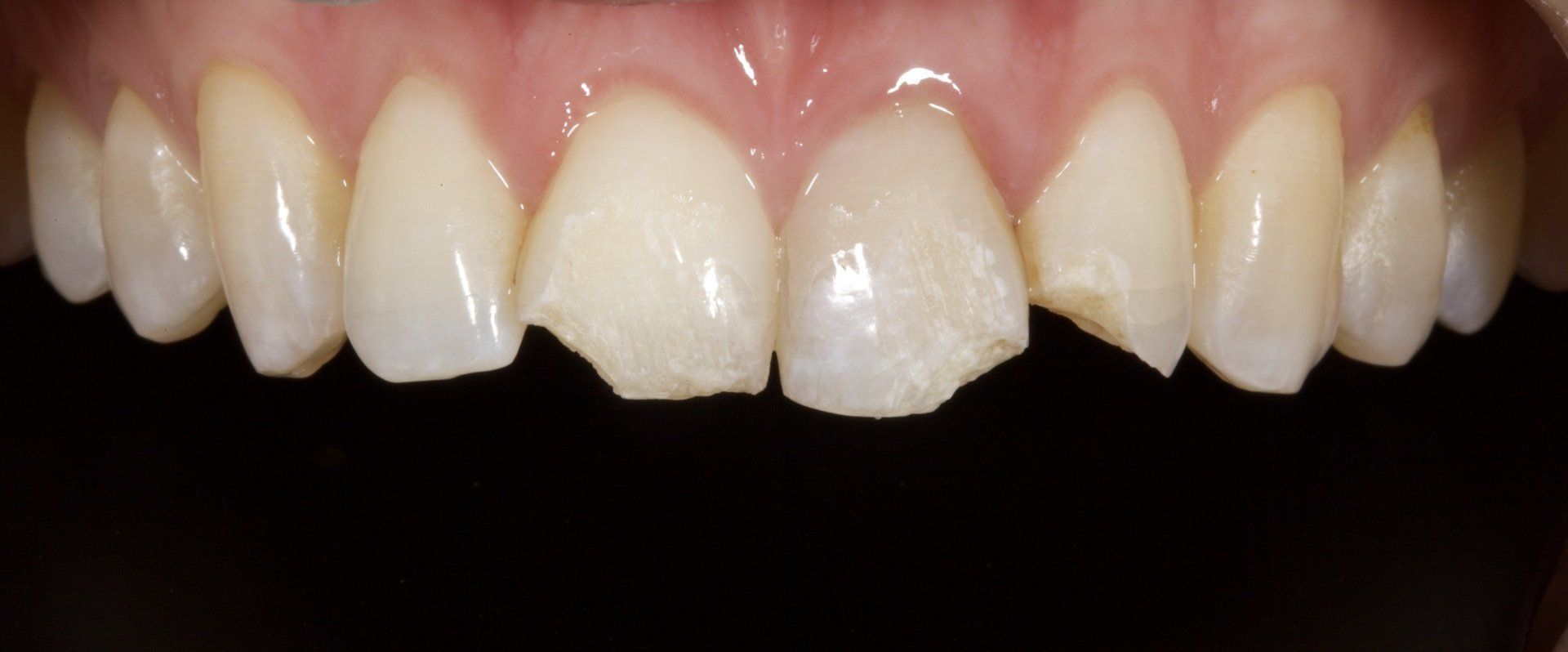 Before Broken Front Teeth — Menai, NSW — Top Care Dental