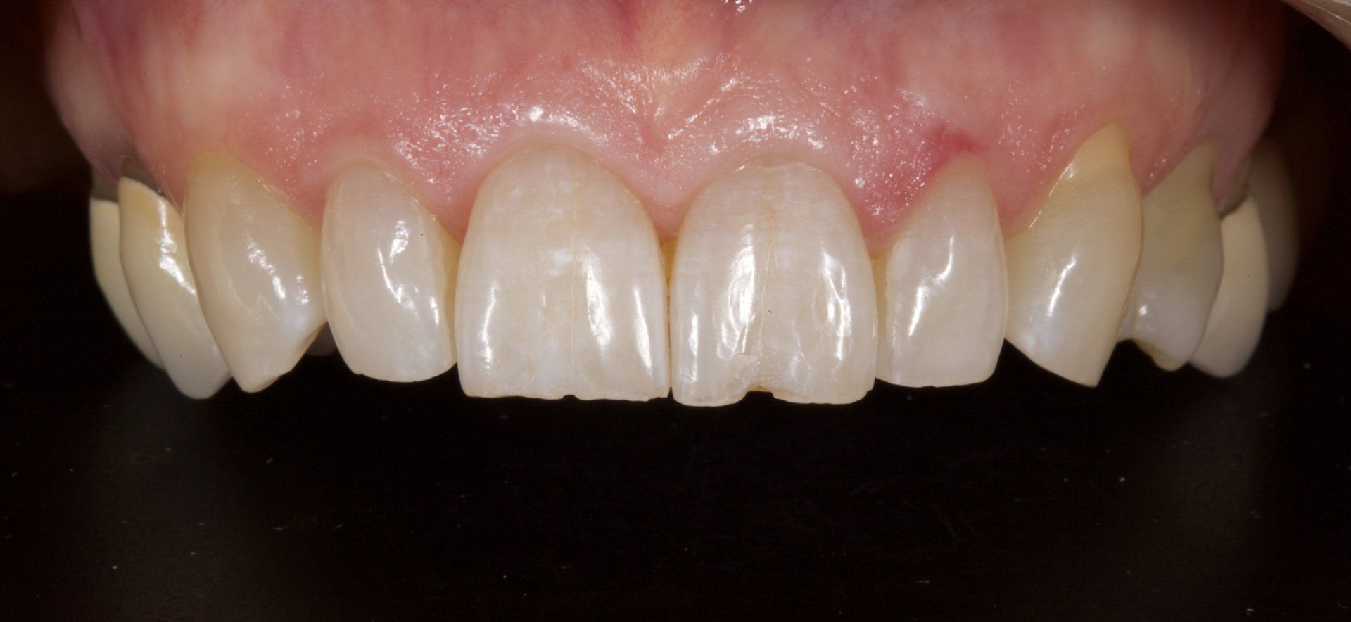 Teeth Before Porcelain Veneers — Menai, NSW — Top Care Dental