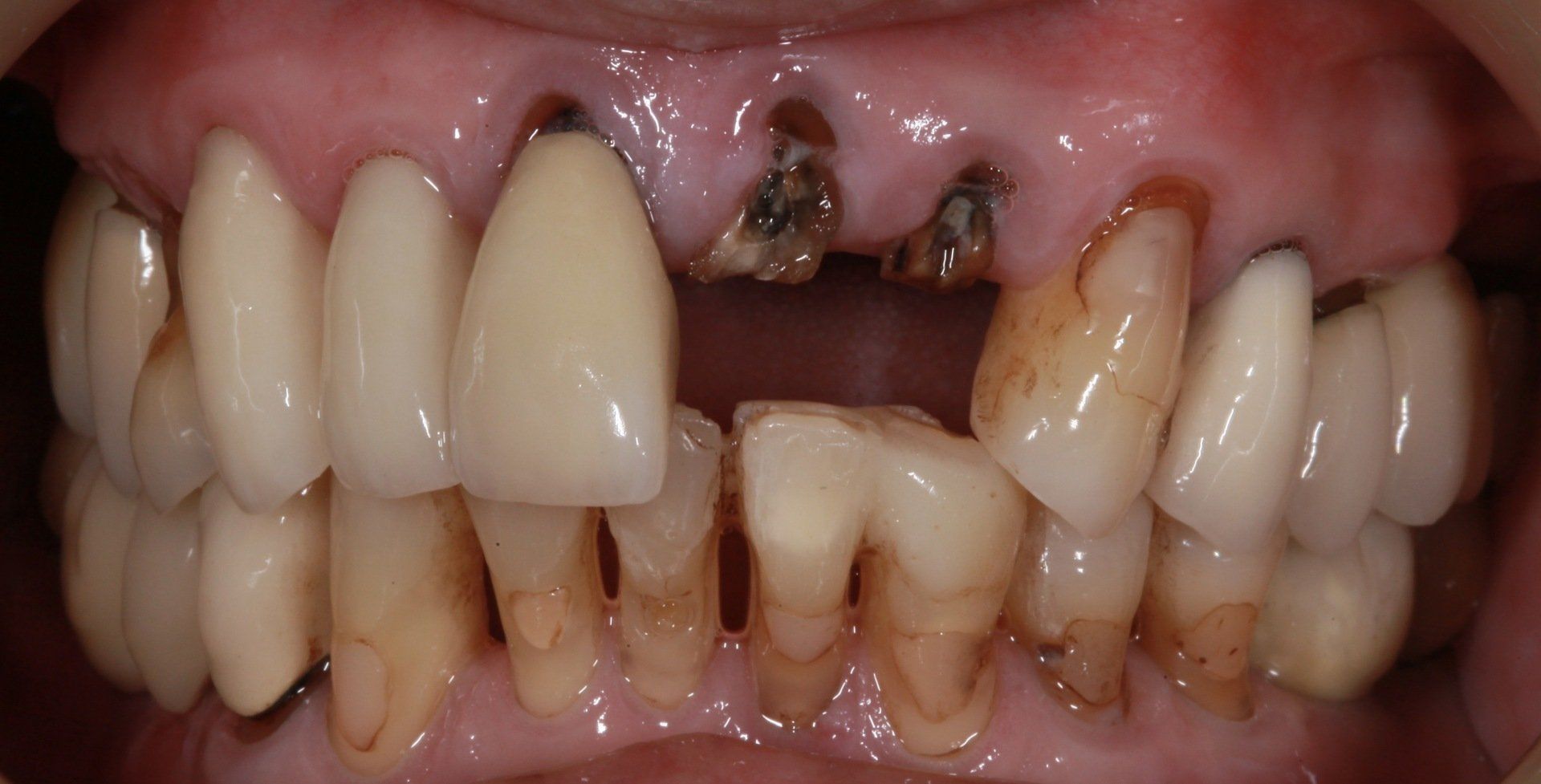 Before Close-Up Damaged Teeth — Menai, NSW — Top Care Dental