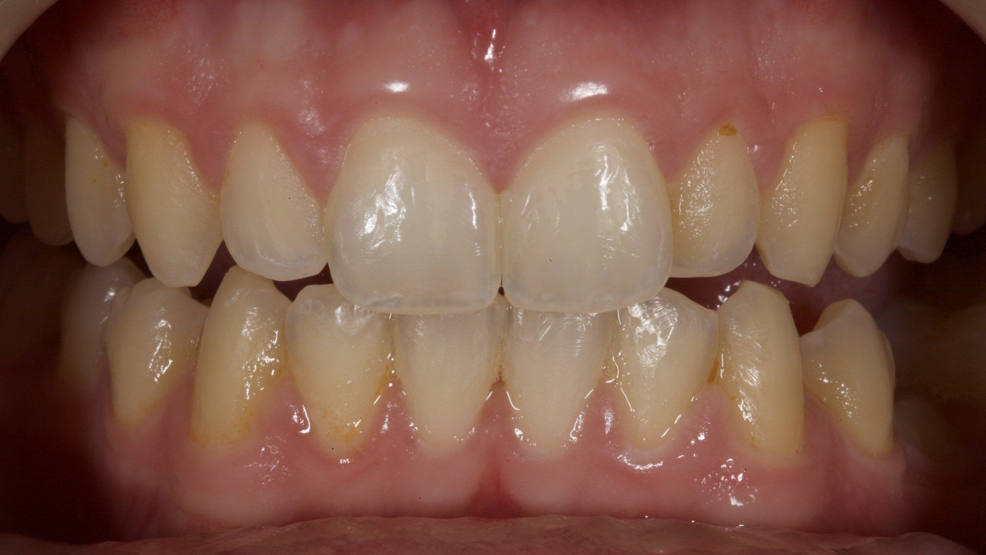 Before Teeth Whitening Close-Up — Menai, NSW — Top Care Dental