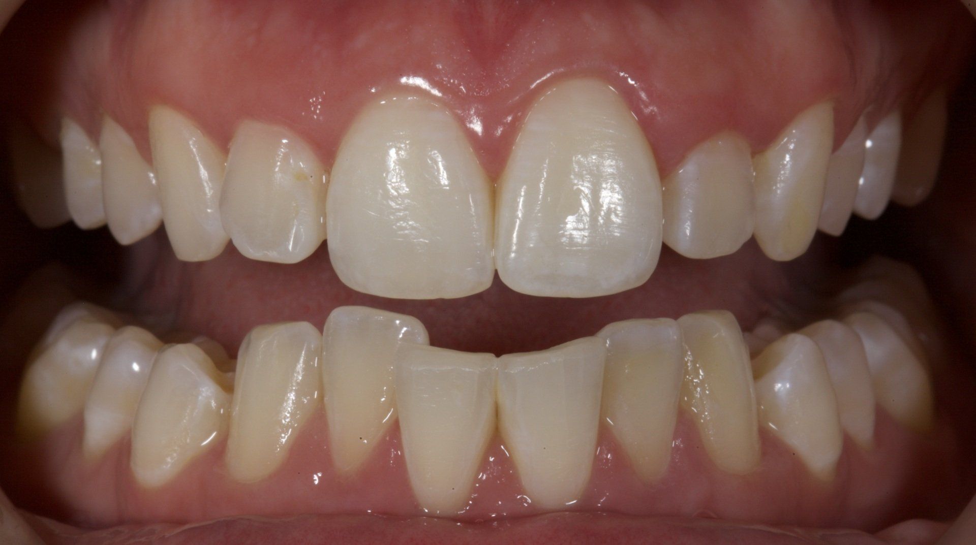 Teeth Whitening Before — Menai, NSW — Top Care Dental
