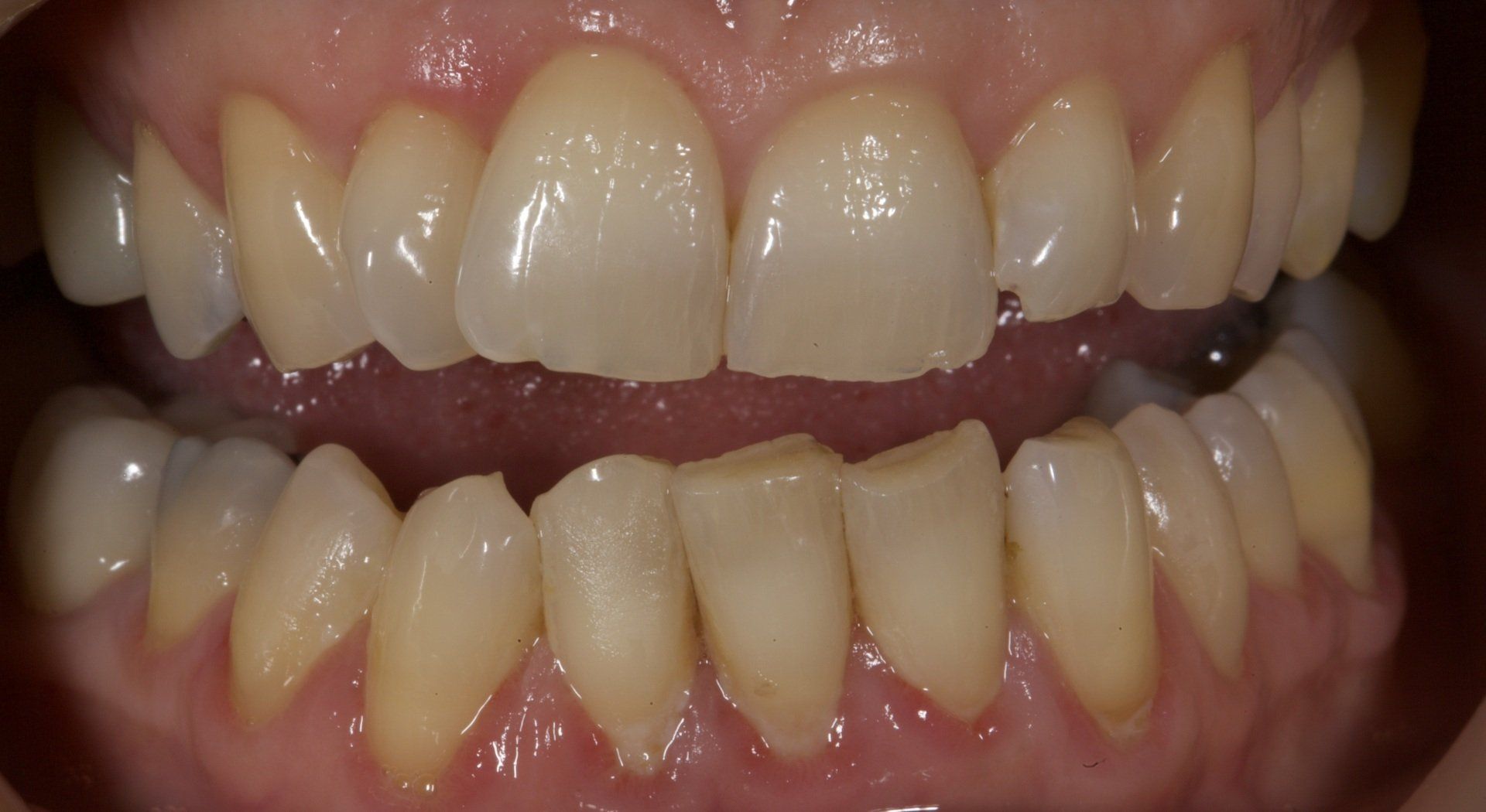 Yellow Teeth Before — Menai, NSW — Top Care Dental