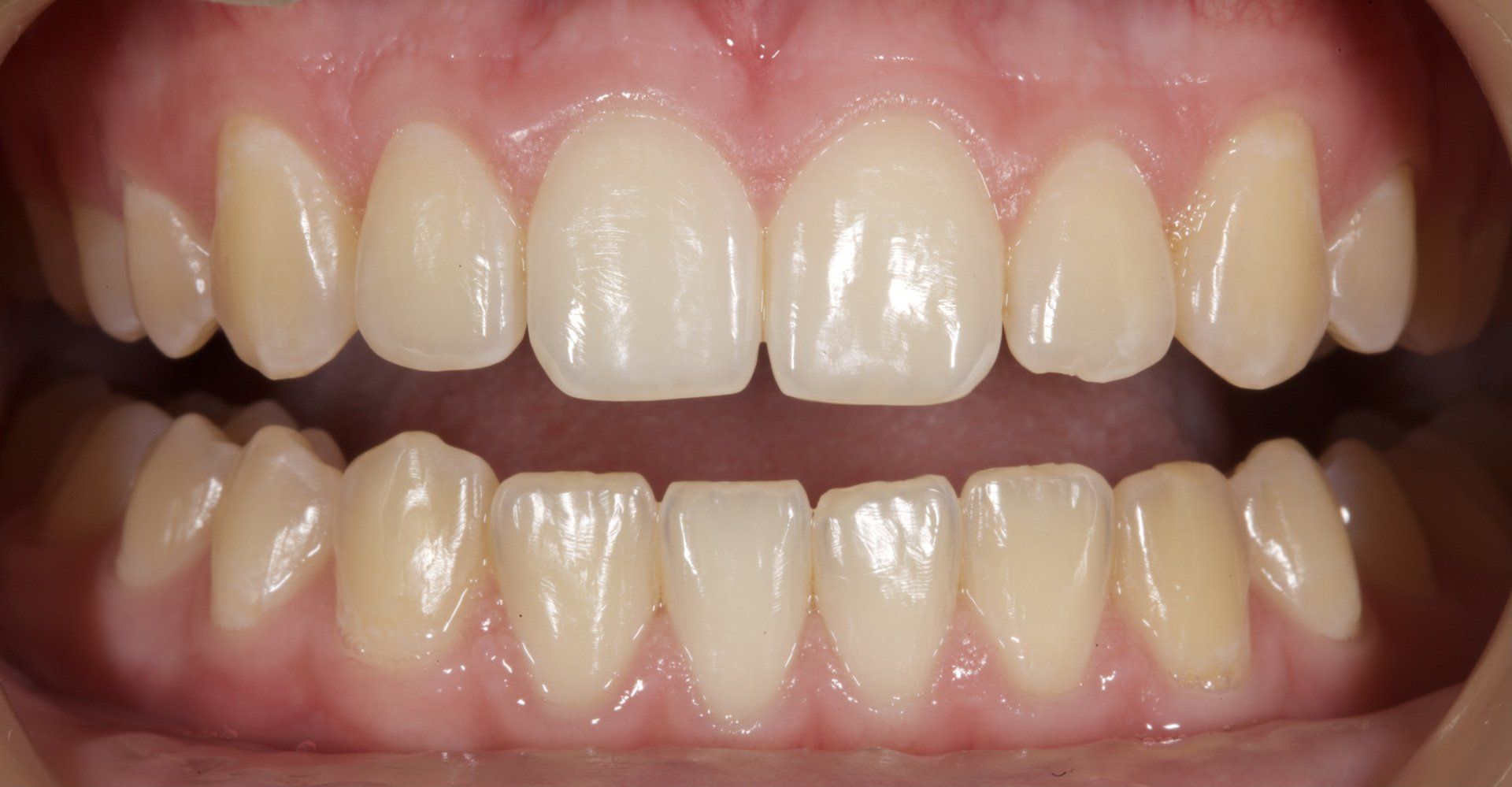Before Teeth Whitening — Menai, NSW — Top Care Dental