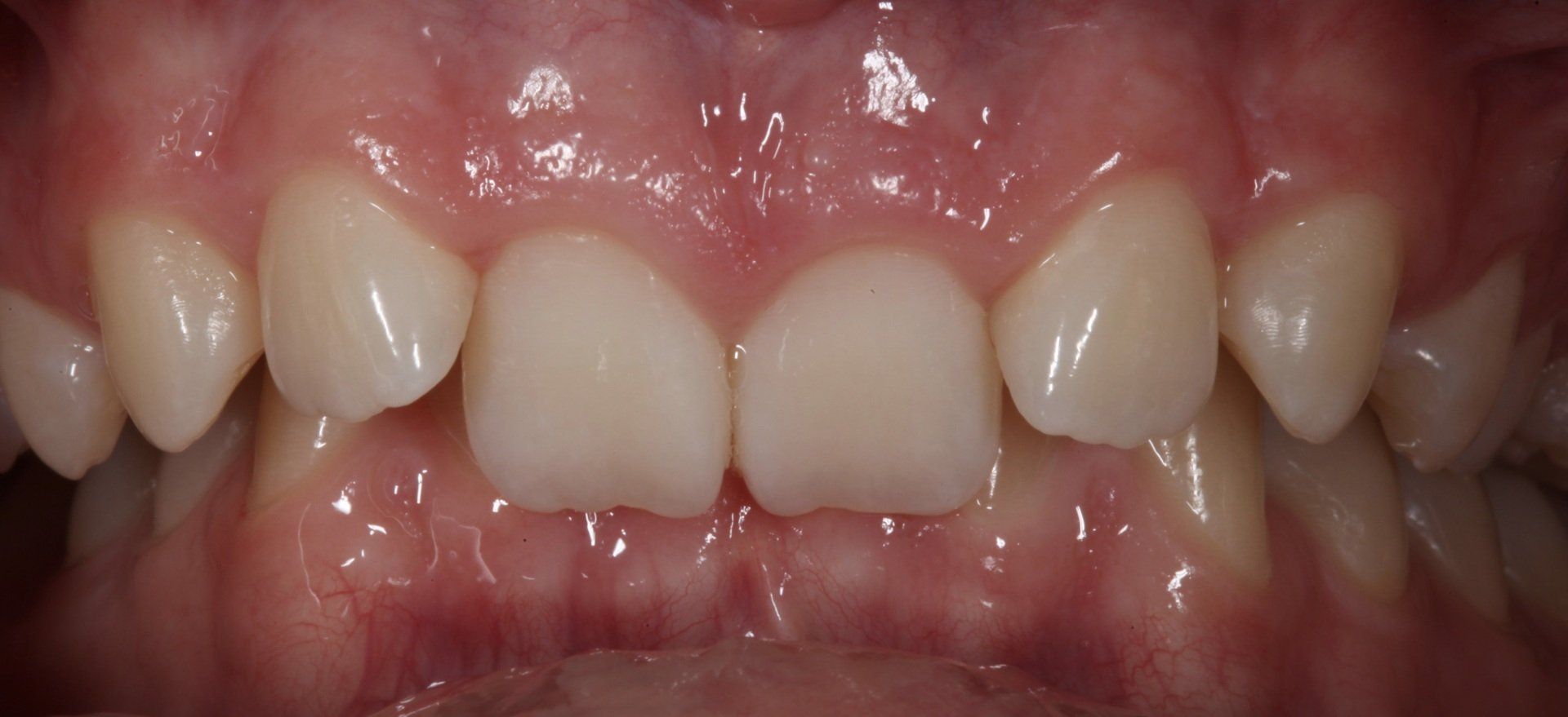 Before Orthodontic — Menai, NSW — Top Care Dental