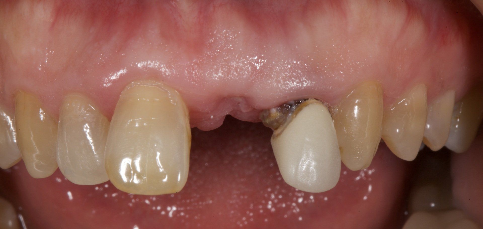 Before Front Teeth Implant — Menai, NSW — Top Care Dental