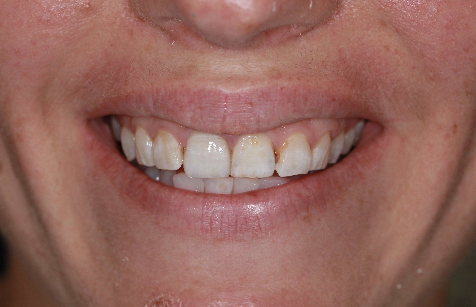 Before Male Teeth — Menai, NSW — Top Care Dental