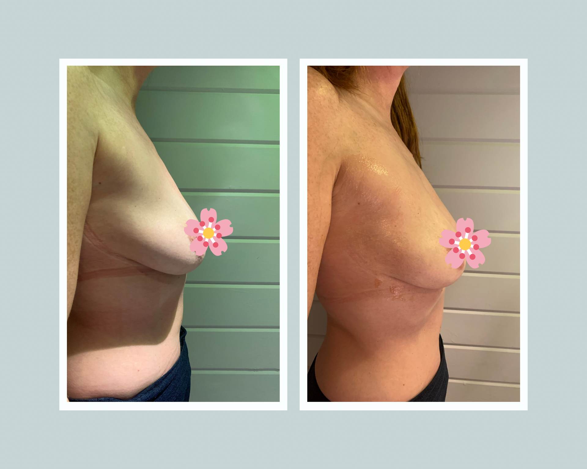 IPL None-Surgical Breast Enhancement