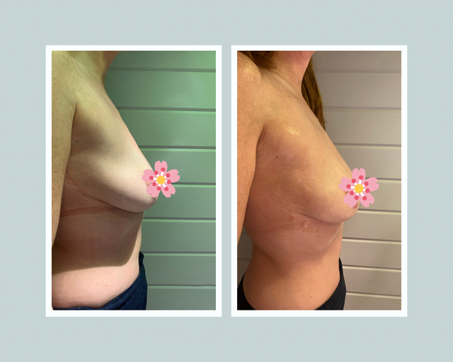 IPL None Surgical Breast Enhancement