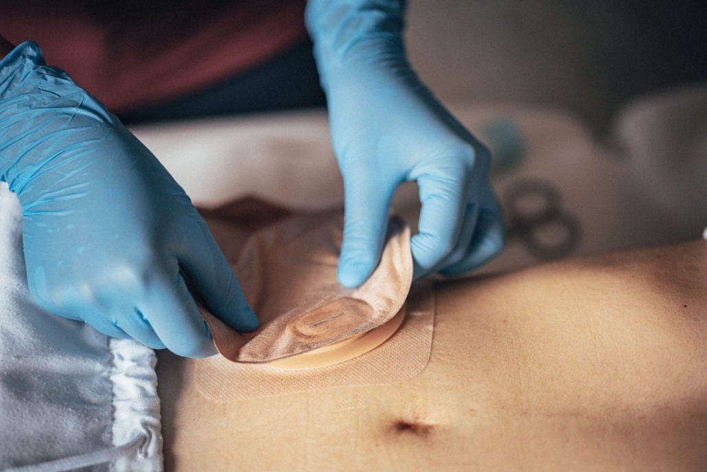 gestione stomie orsitano