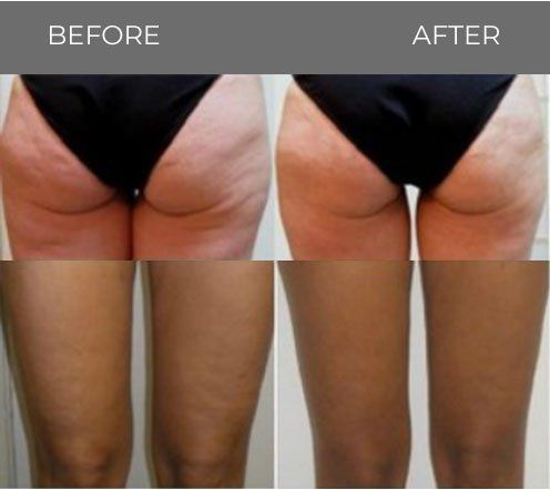 Before and after shot of woman's legs and buttocks — Minneapolis, MN — InstaSculpting Body Contour Center
