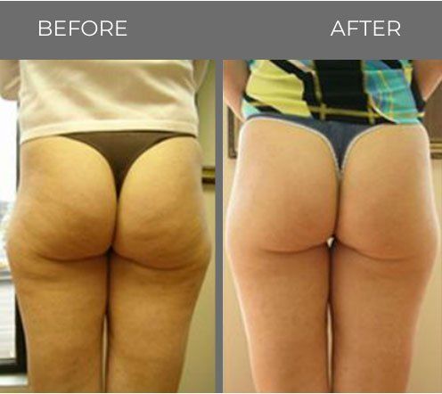 Before and after cellulite treatment — Minneapolis, MN — InstaSculpting Body Contour Center