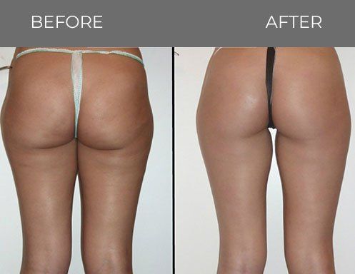 Before and after shot of female hips — Minneapolis, MN — InstaSculpting Body Contour Center