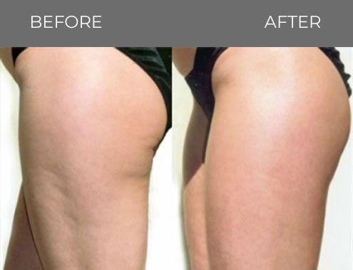Before and after side shot of female hips — Minneapolis, MN — InstaSculpting Body Contour Center